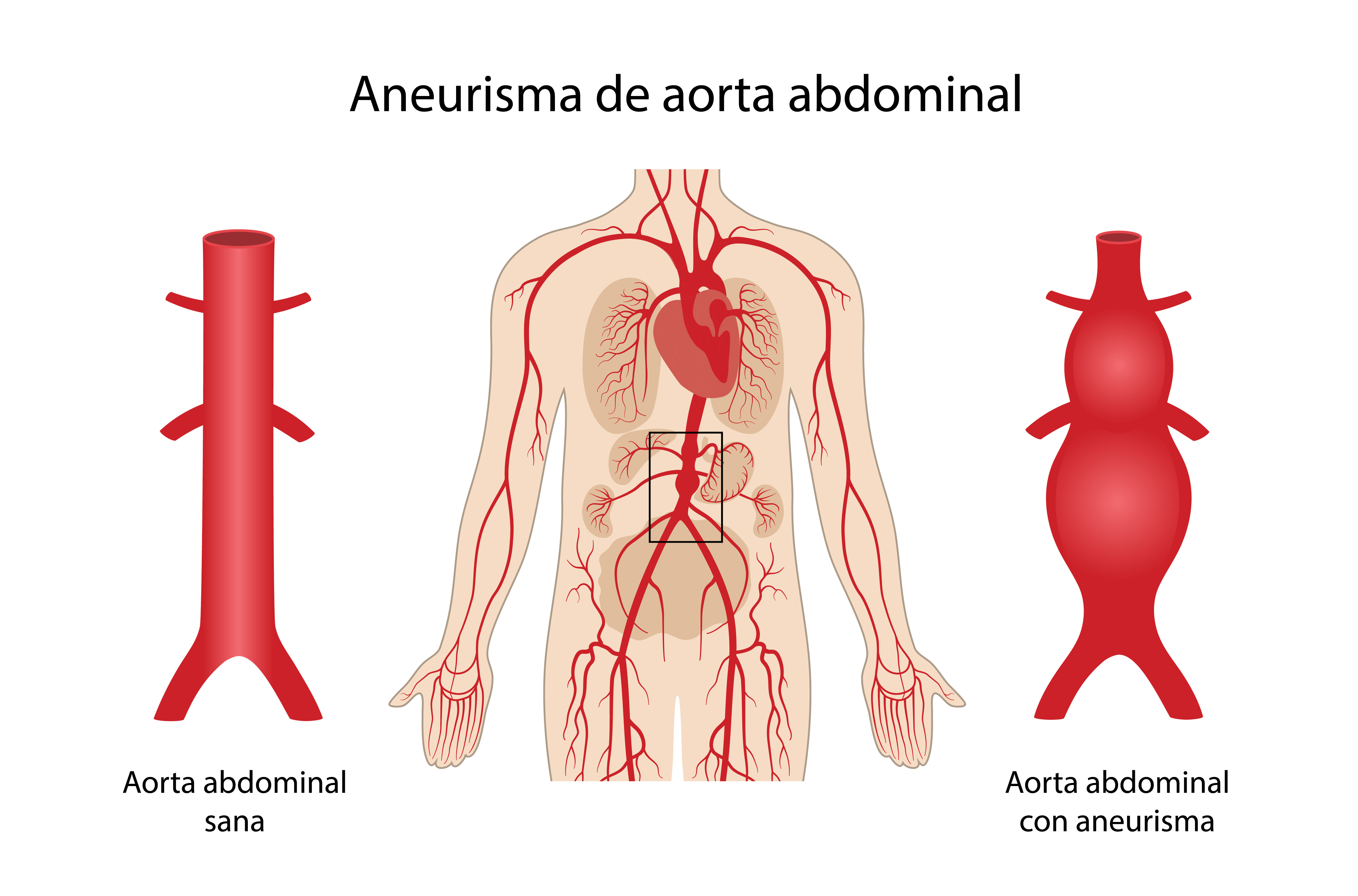 Aorta abdominal con aneurisma